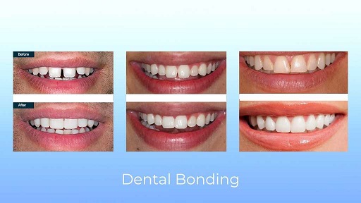 Dental Bonding