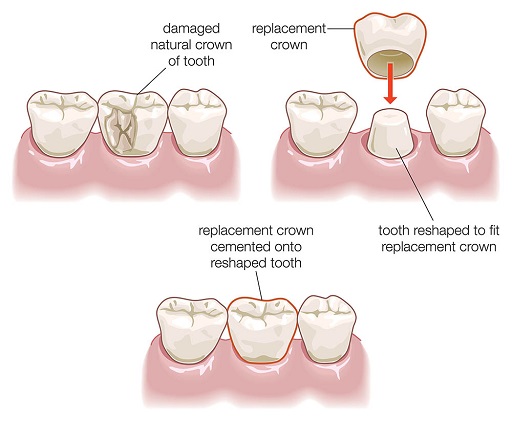 Dental Crowns