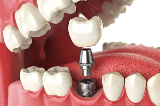 Dental Implants