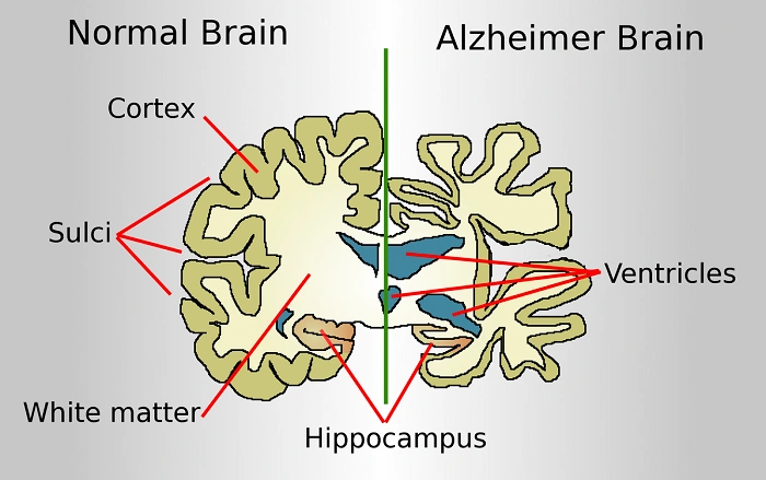 Alzheimers Disease 1