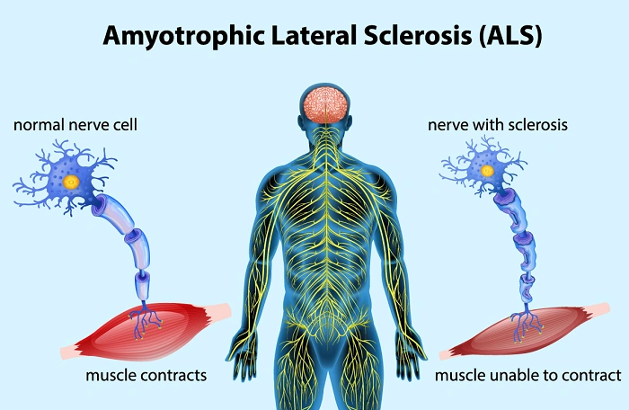 Amyotrophic Lateral Sclerosis ALS 1