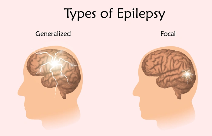 Epilepsy 1