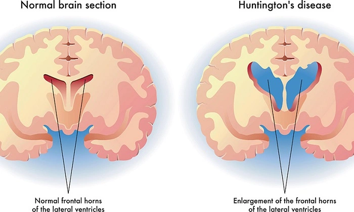 Huntingtons Disease 1