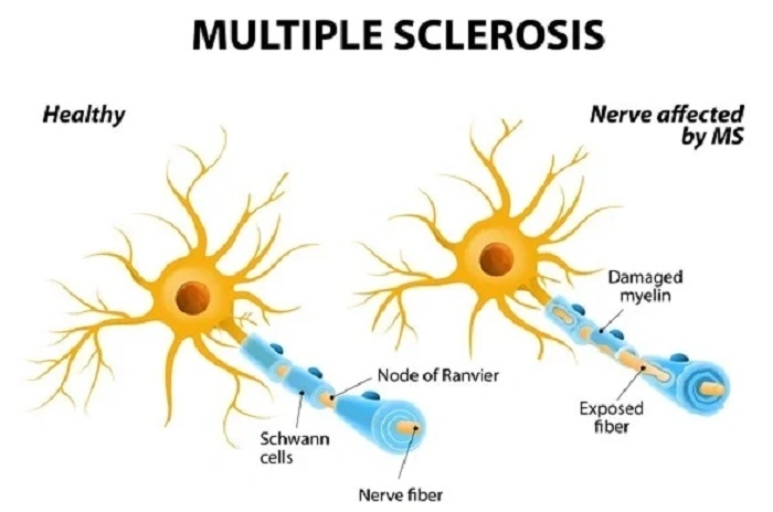Multiple Sclerosis MS 1