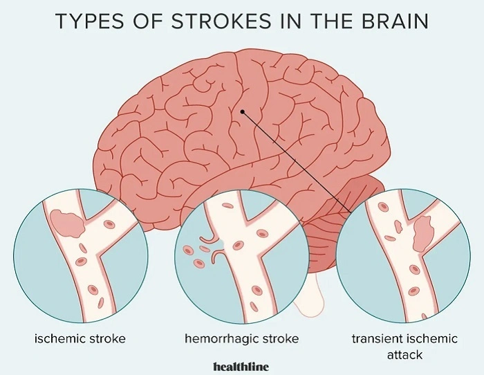Stroke 1